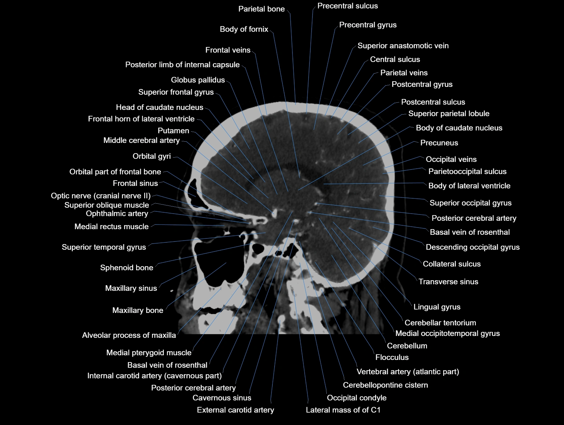 CT scan brain sagittal cross sectional anatomy image-img-00001-00031.webp
